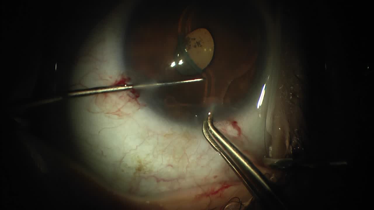 Explanting an Anterior Chamber Phakic IOL