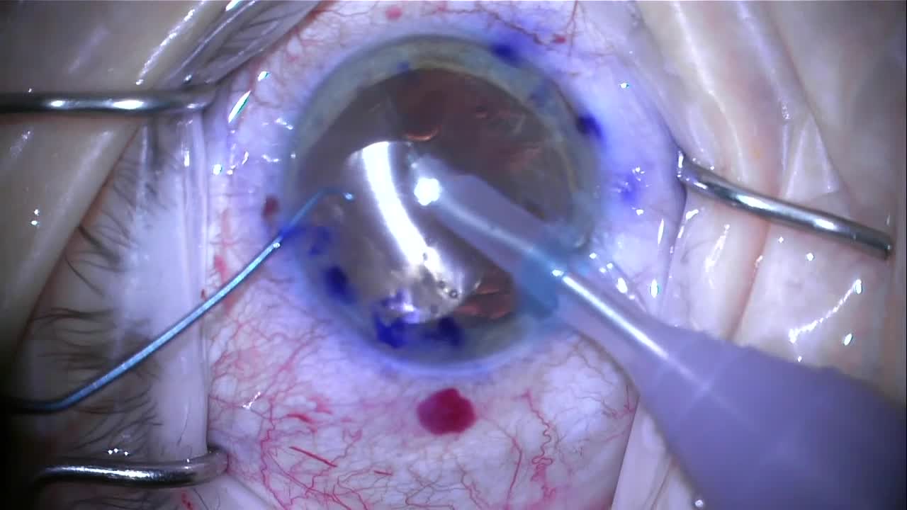 Rescue of a Large Anterior Capsular Tear