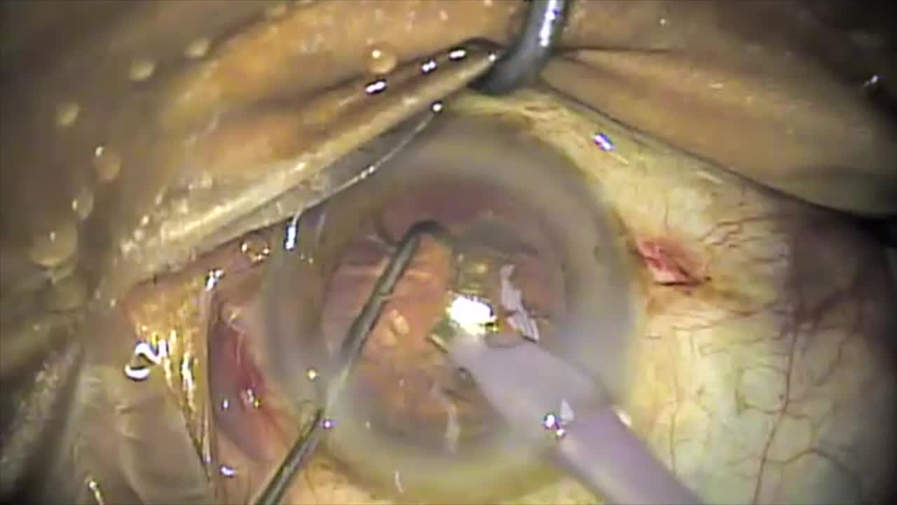 BSS Protecting Posterior Capsule During Phacoemulsification