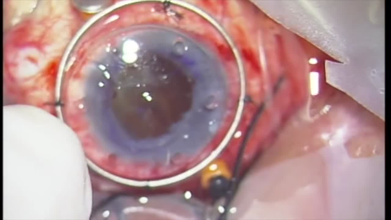 Ocular Trauma of War