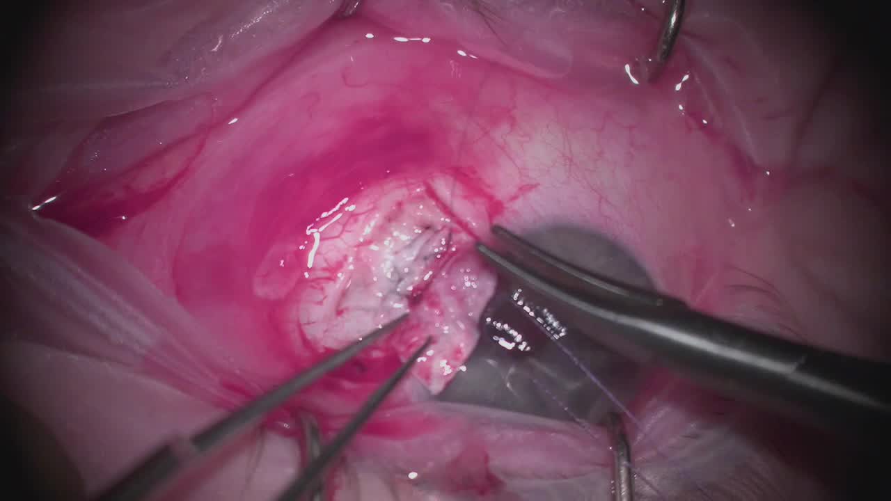 Cyclodialysis Repair