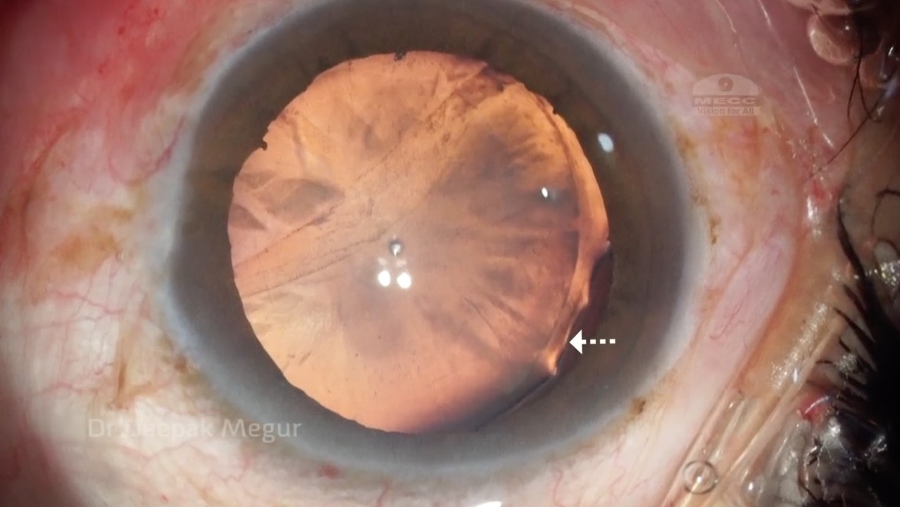 Traumatic Subluxated Cataract Managed with Phaco, CTR, and Multipiece IOL in Sulcus with Optic Capture