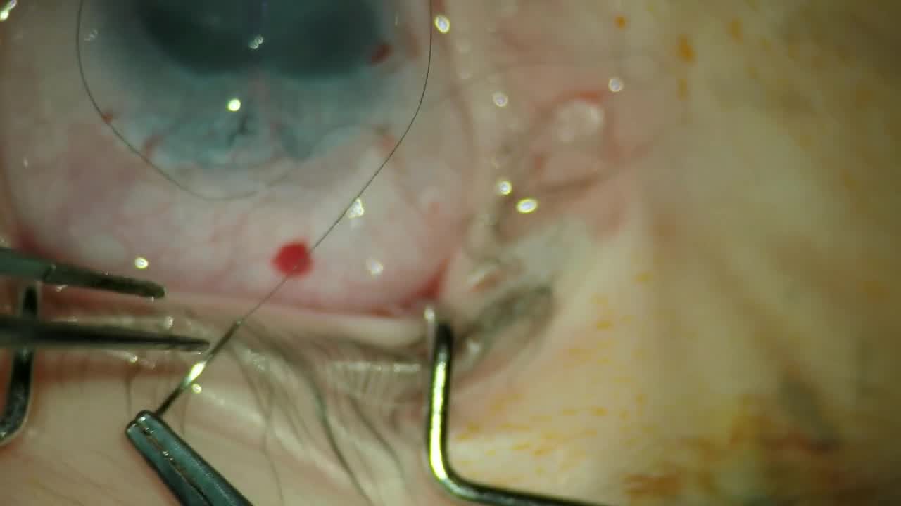 Trabeculectomy, MMC, and Amniotic Membrane in a Child With Peters Anomaly