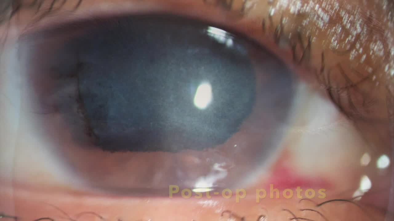 A Modified Lamellar Pocket Technique for Corneal Tattooing