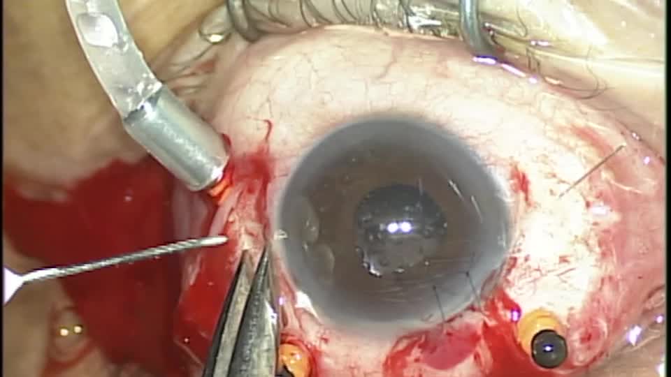 IOL Fixation