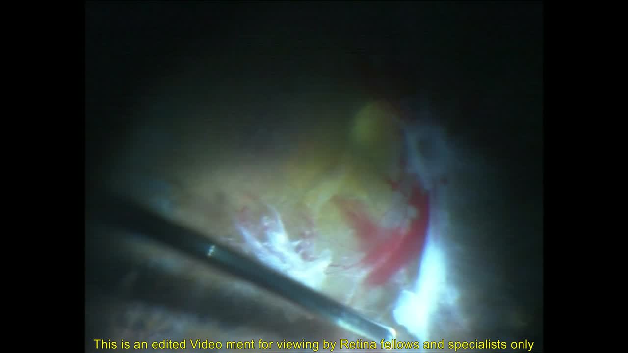 One-handed High Speed Dissections and ILM Peeling for PDR