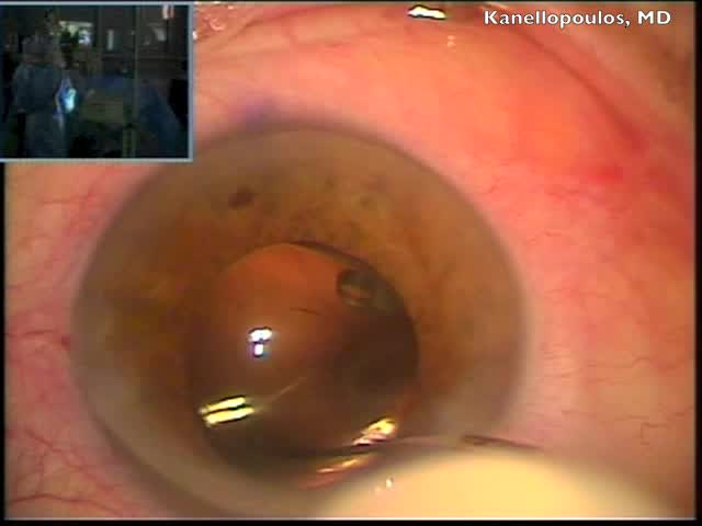Cataract Extraction and Trifocal IOL Alcon Panoptix Implantation