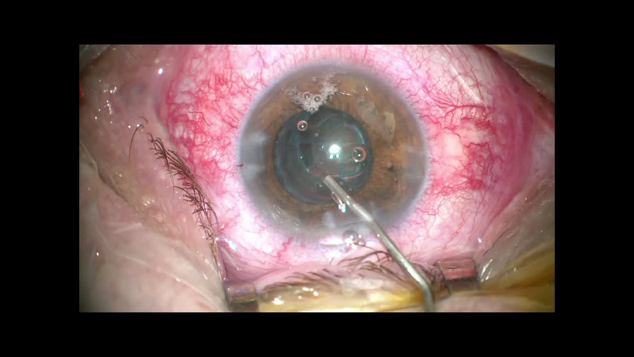 Traumatic Cataract, Laser Cataract Surgery, and Toric IOL