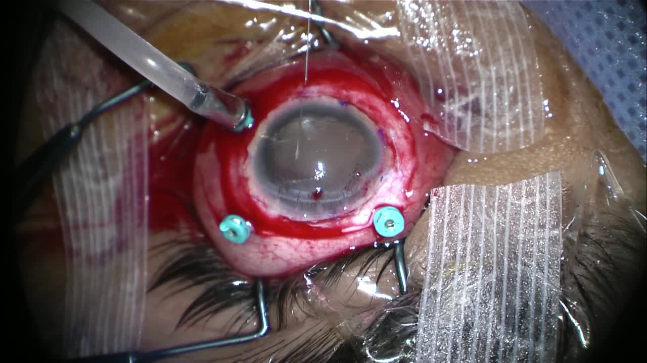 Innovation in Aniridia PVR Retinal Detachment
