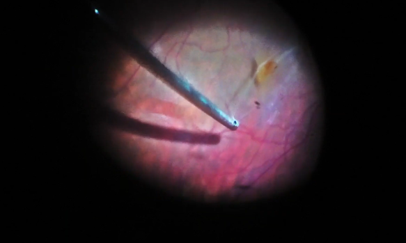 Triple Peel of Taut Hyaloid, ERM, and ILM for Vitreomacular Traction Syndrome