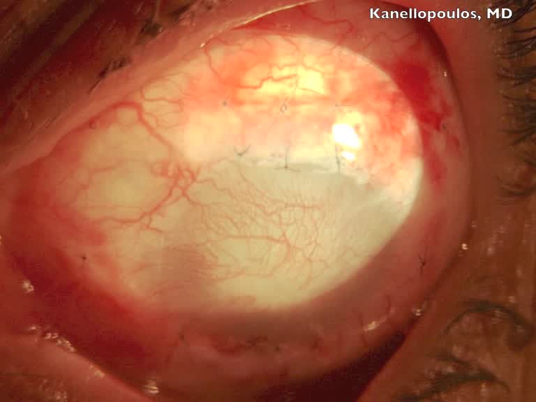 Keratoplasty and Cataract Removal in a Patient With Severe Iatrogenic Ocular Surface Disease