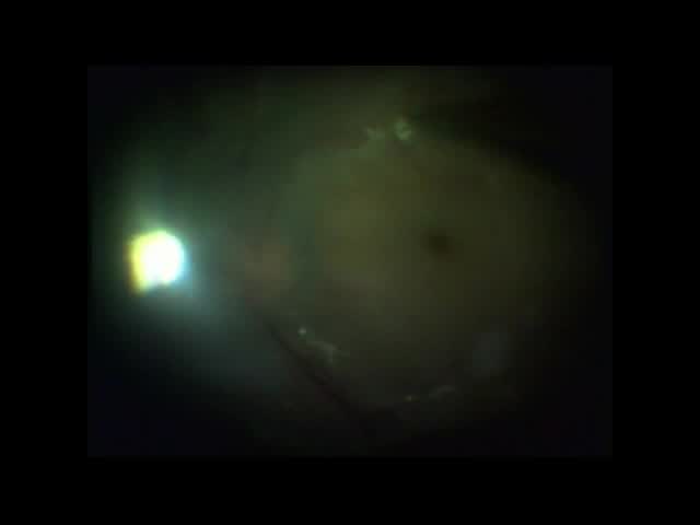 Giant Tear & Recurrent PVR
