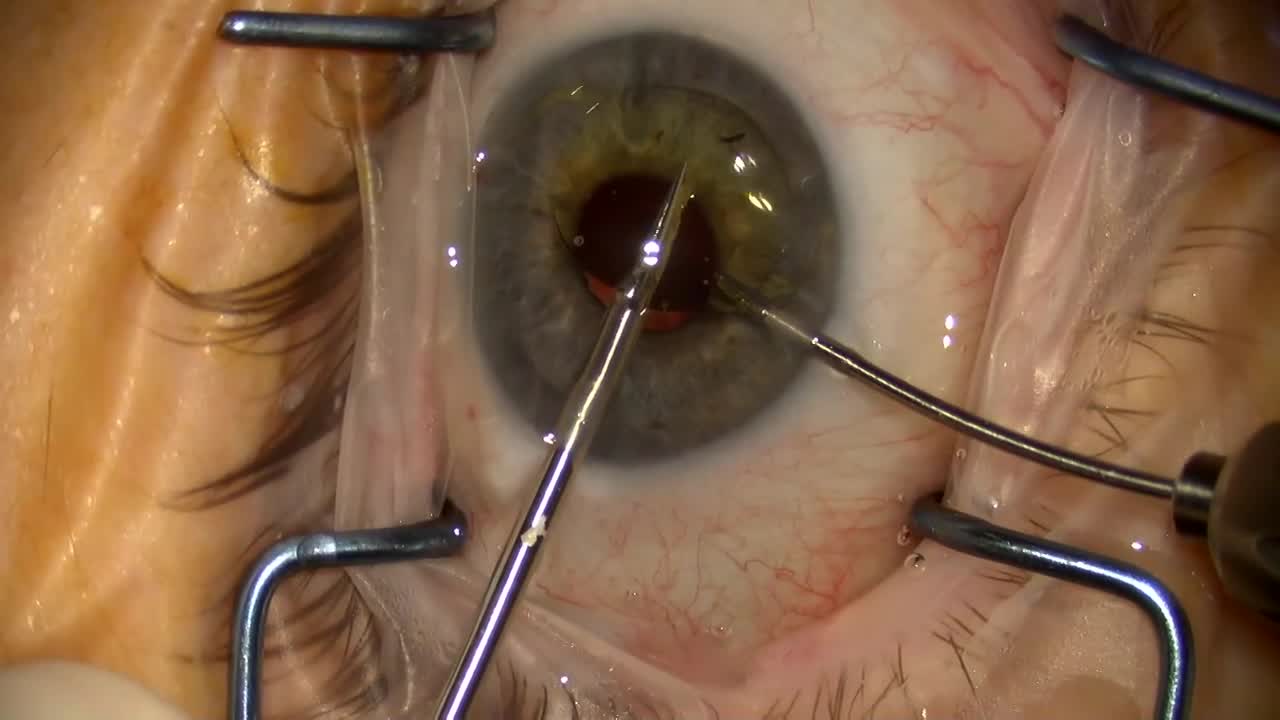 IOL Removal Tips