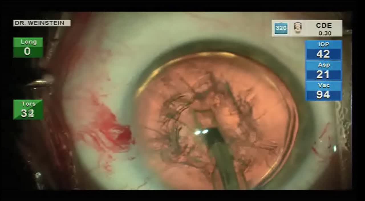 Standard Cataract Surgery Technique