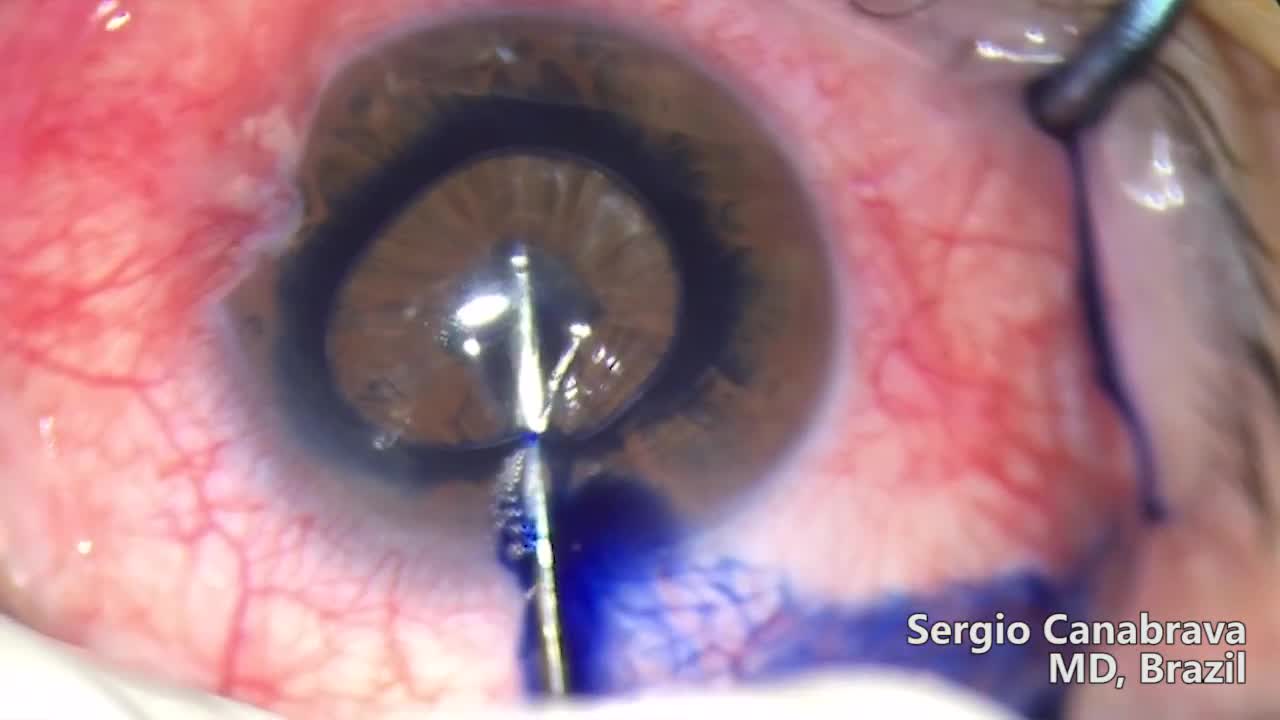 Blue Bubble - New management for Small Pupil and Synechiae + Canabrava Ring