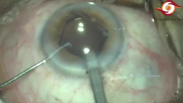 Tips and Tricks for Maluygin Ring Insertion and Removal