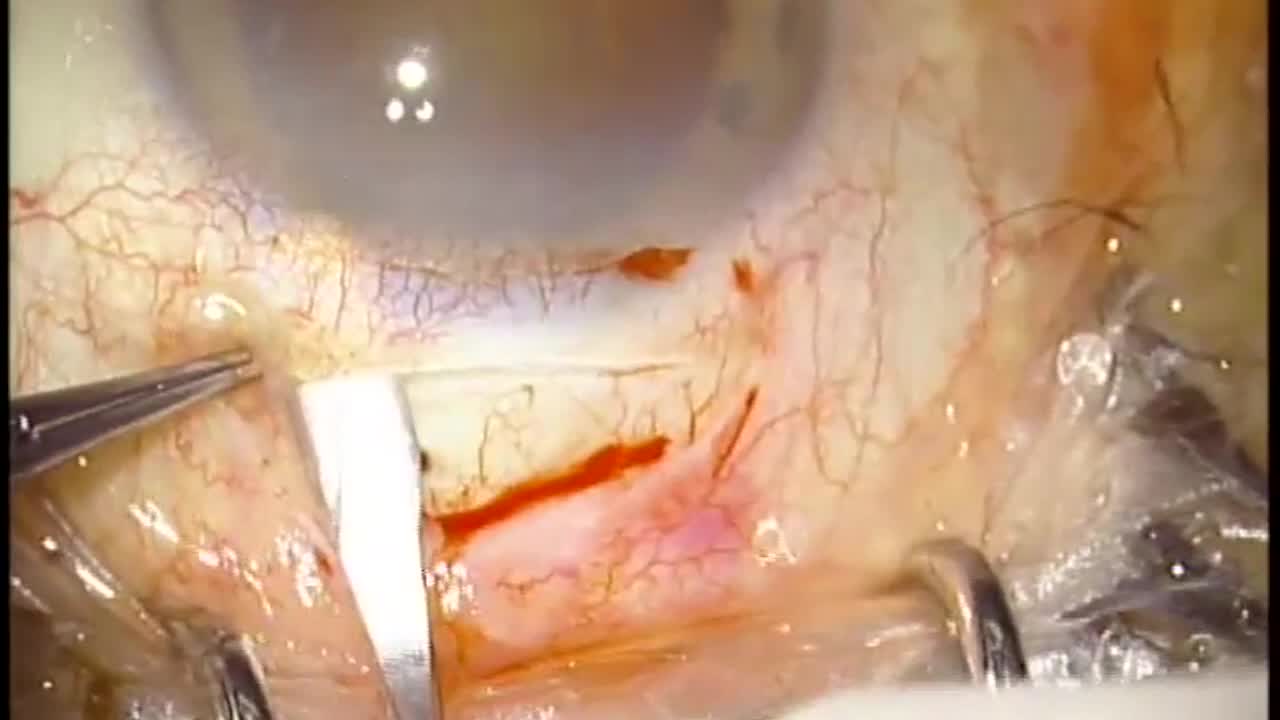 Manual Incision Cataract Surgery
