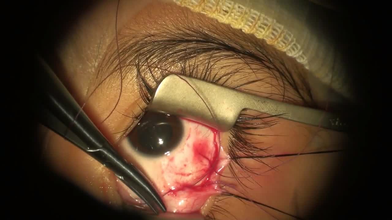 Lateral Rectus Recession and Inferior Oblique Anterior Transposition