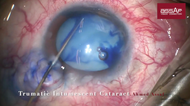 Milky White Cataract With Pupillary Block