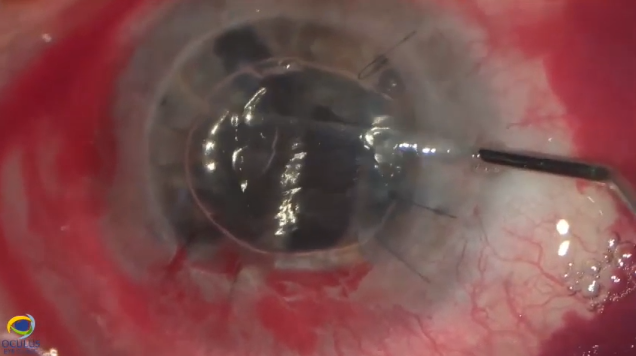 DSAEK for Decompensated Penetrating Graft on ICE Syndrome