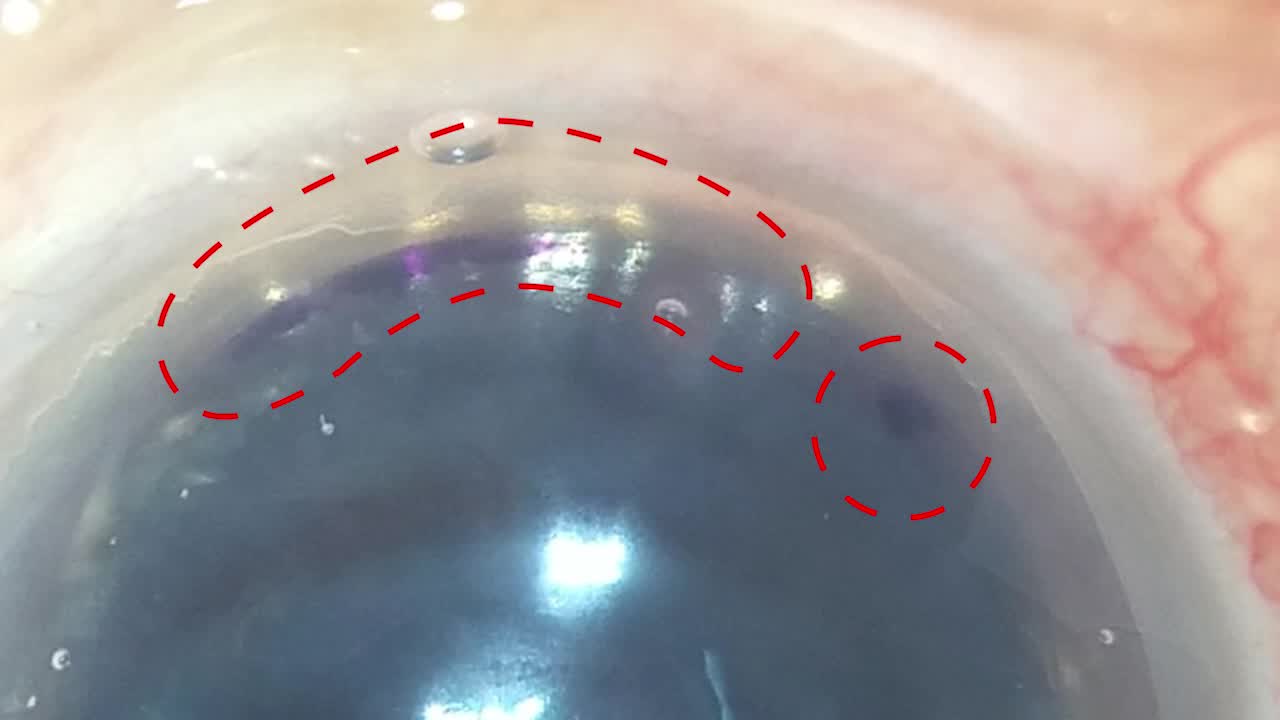 Dot-Line Lynch Technique in DMEK