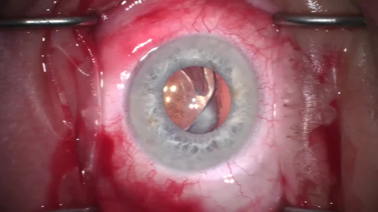 PXF Dislocated IOL, IOL Exchange  with Gortex Sutured IOL