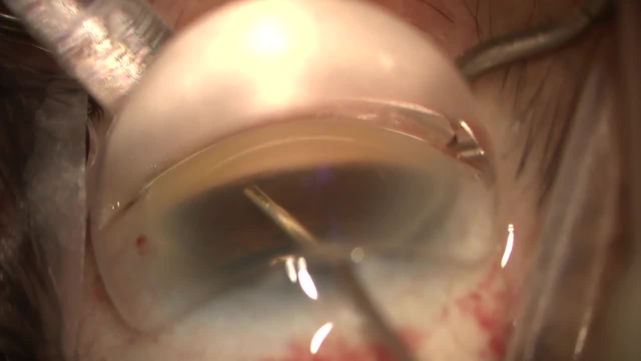 iStent inject with FLACS and ORA Guided Toric IOL Implantation