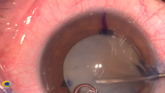 Tips and Tricks for Successful Phacoemulsification of a Morganian Cataract