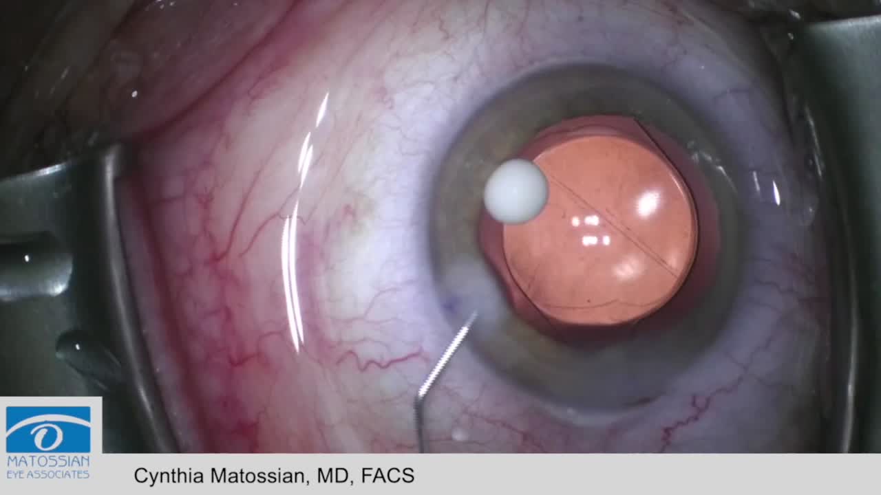 Dexycu Insertion Into the Eye at the Conclusion of Cataract Surgery