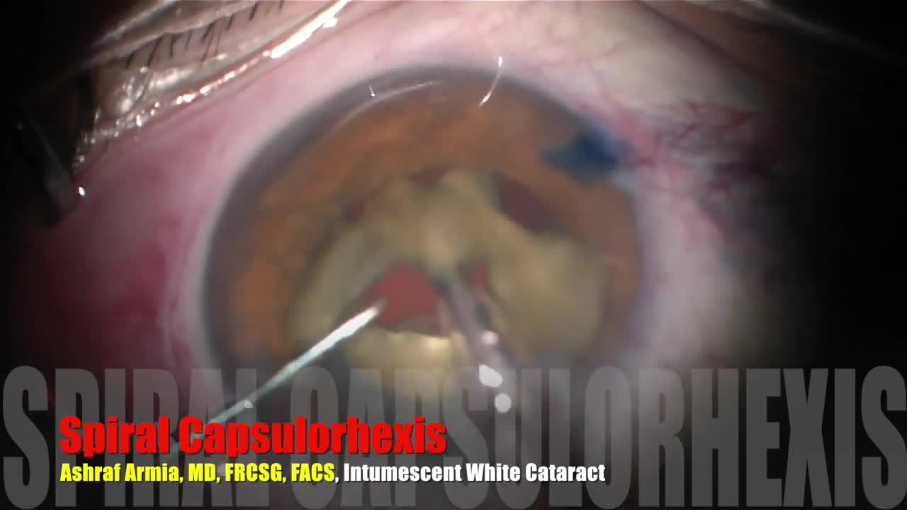 Classic Spiral Capsulorhexis in a White Intumescent Cataract to Prevent Argentinian Flag