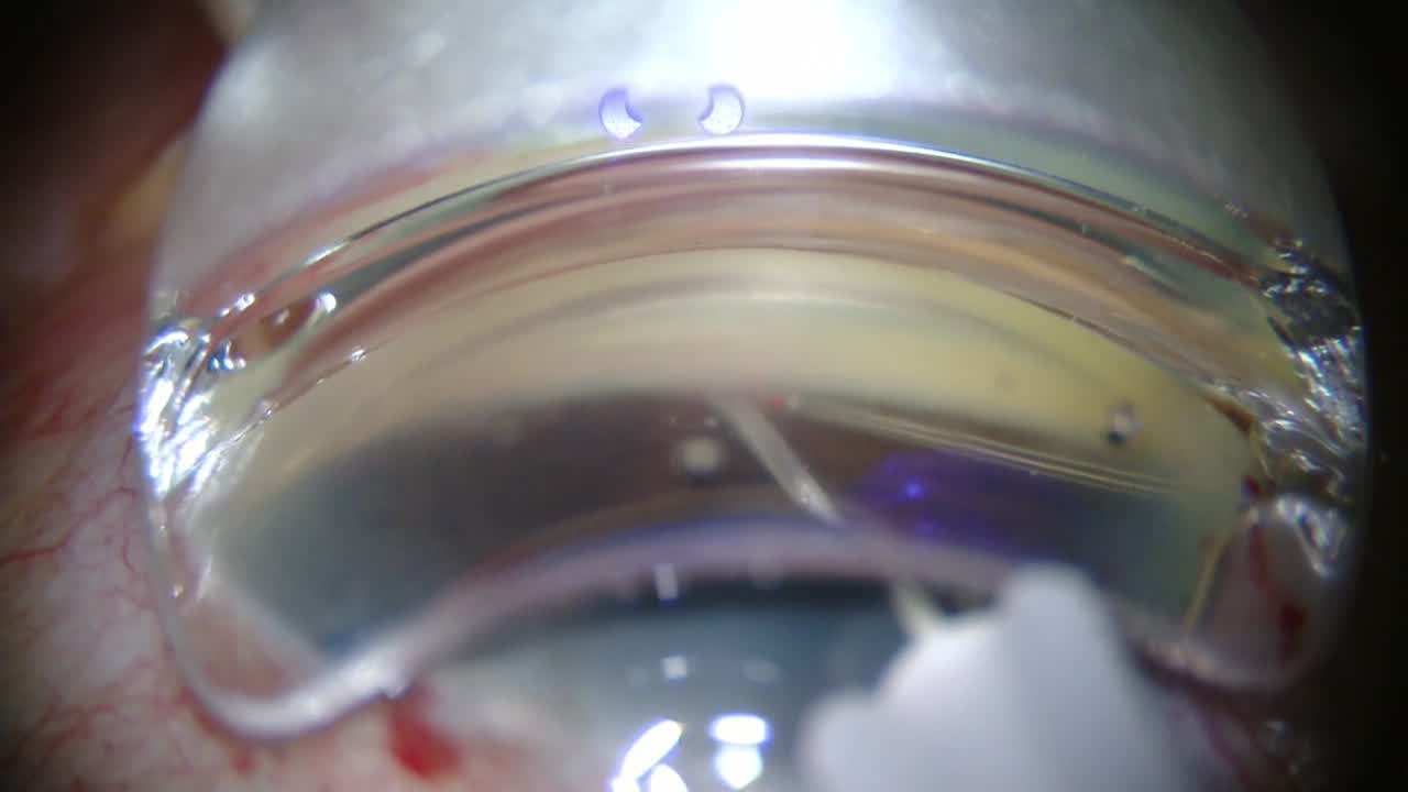 Ab-Interno Canaloplasty (ABIC) with Ellex iTrack Catheter