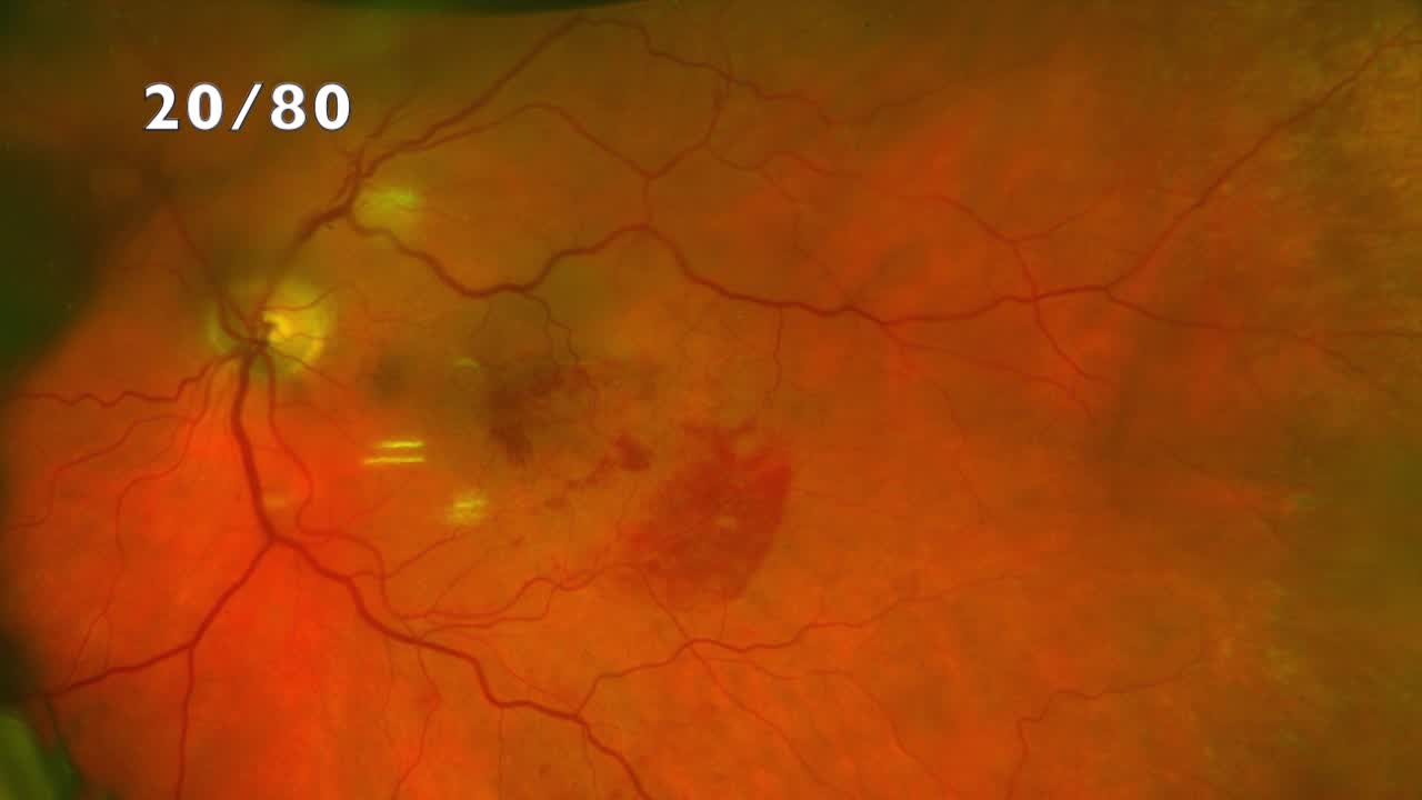 Iatrogenic Retinal Detachment During Submacular Surgery