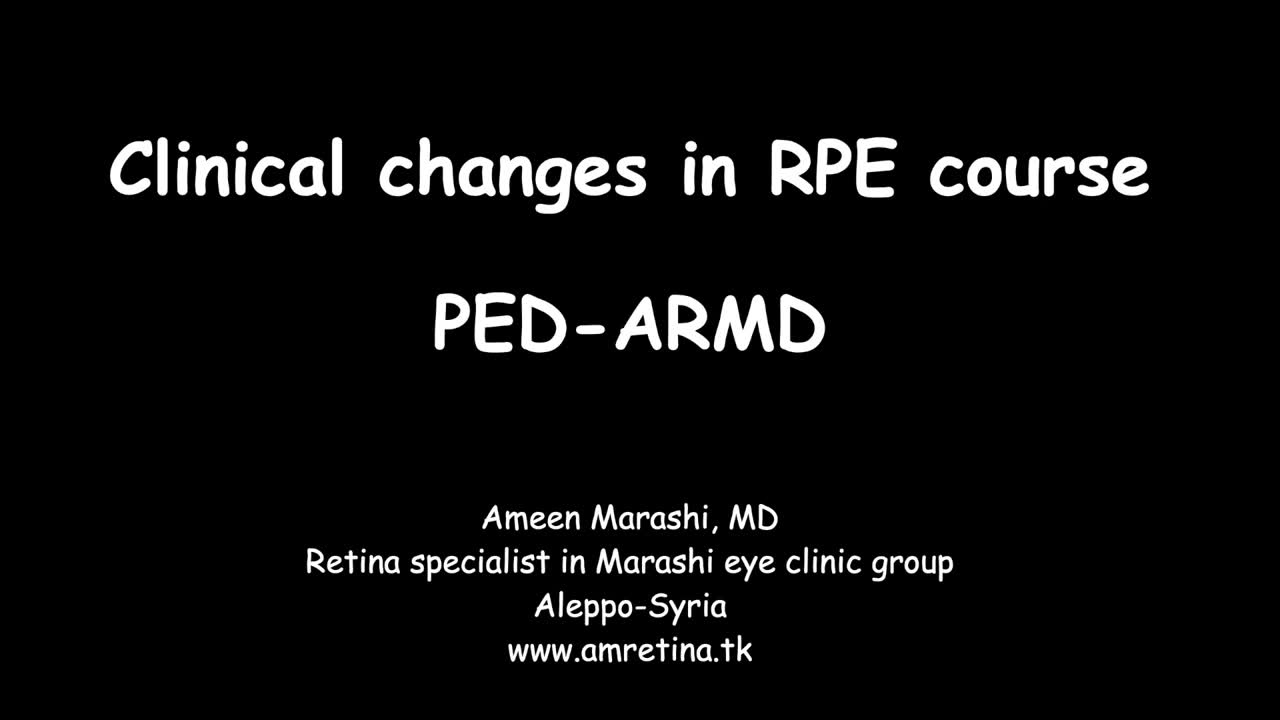Pigment Epithelial Detachments in AMD
