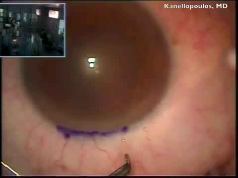 Limbal Stem Cell Autograft 