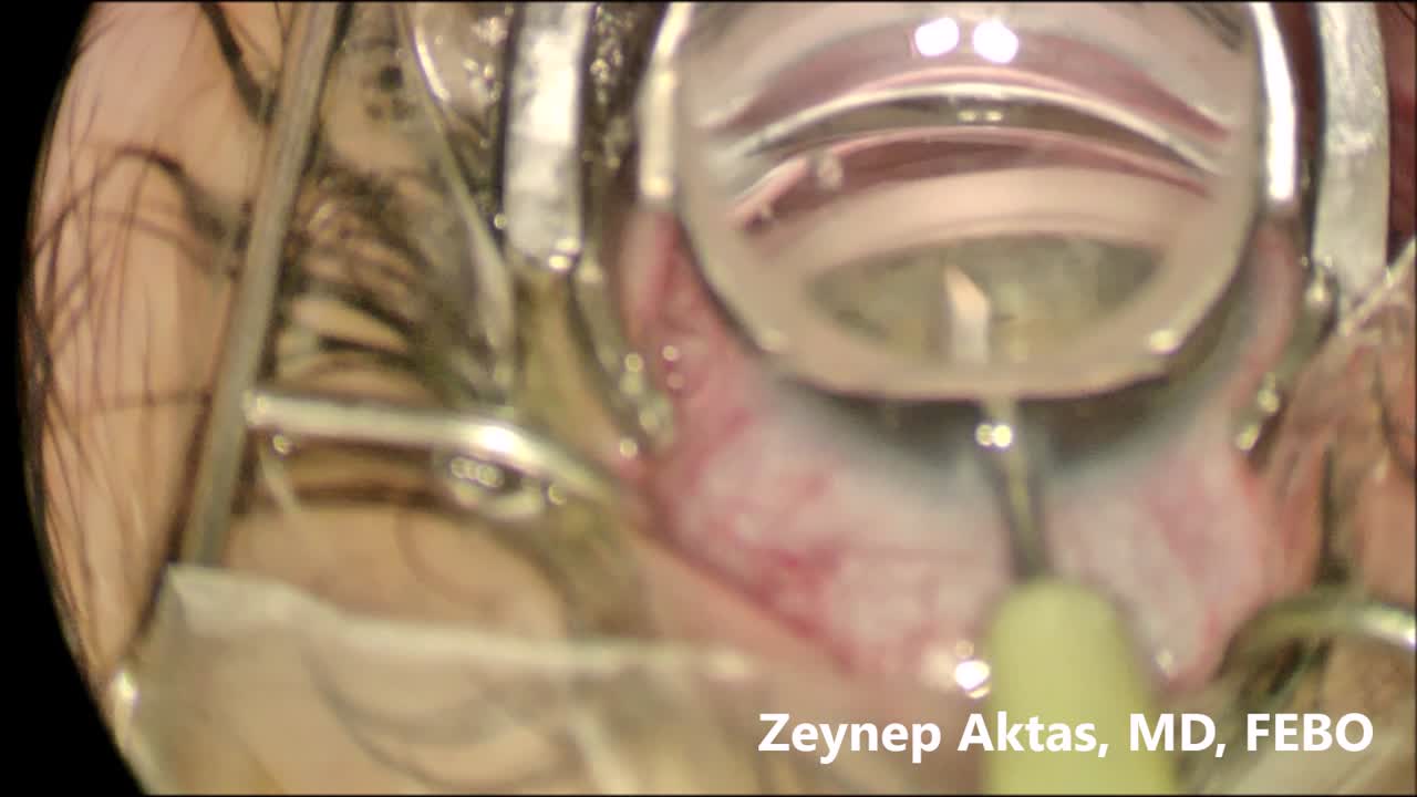 GATT In a Case With Juvenile Glaucoma 