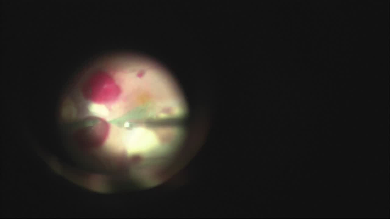 Vitrectomy and ILM Peel for Terson Syndrome