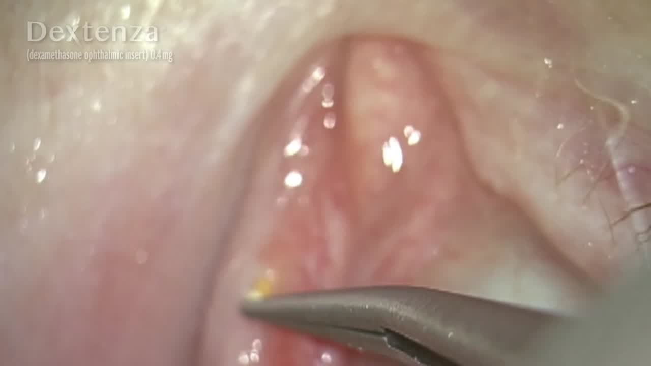 Dextenza Intracanalicular Insert at the Conclusion of Cataract Surgery