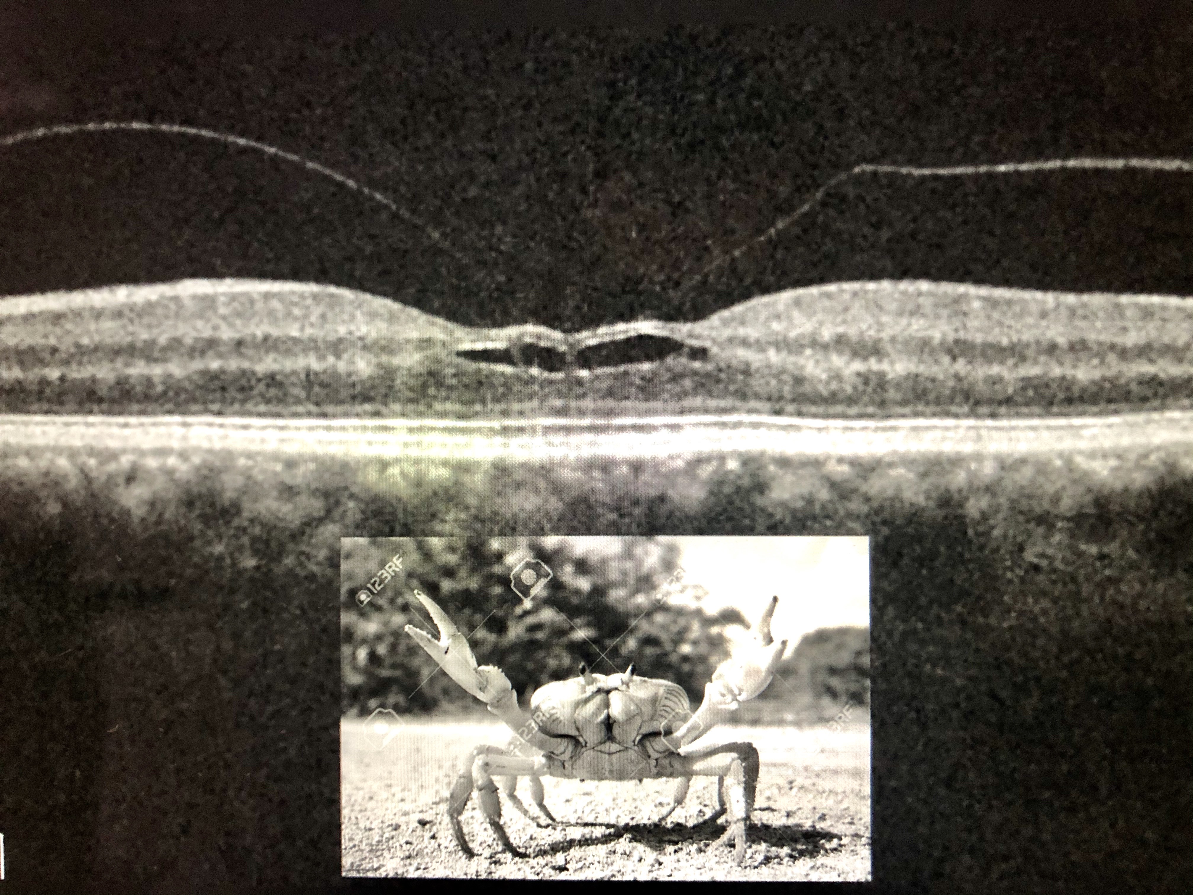 VMT With Taut Hyaloid ILM Peel: Brilliant Blue Technique