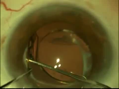 Solving Z Crystalens Problem