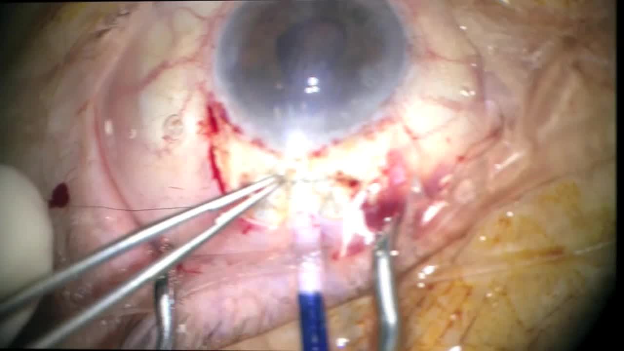 Advanced Triple Procedure DMEK Combined with Anterior Chamber IOL Explantation and Iris Claw IOL Implantation As a Single Stage Procedure