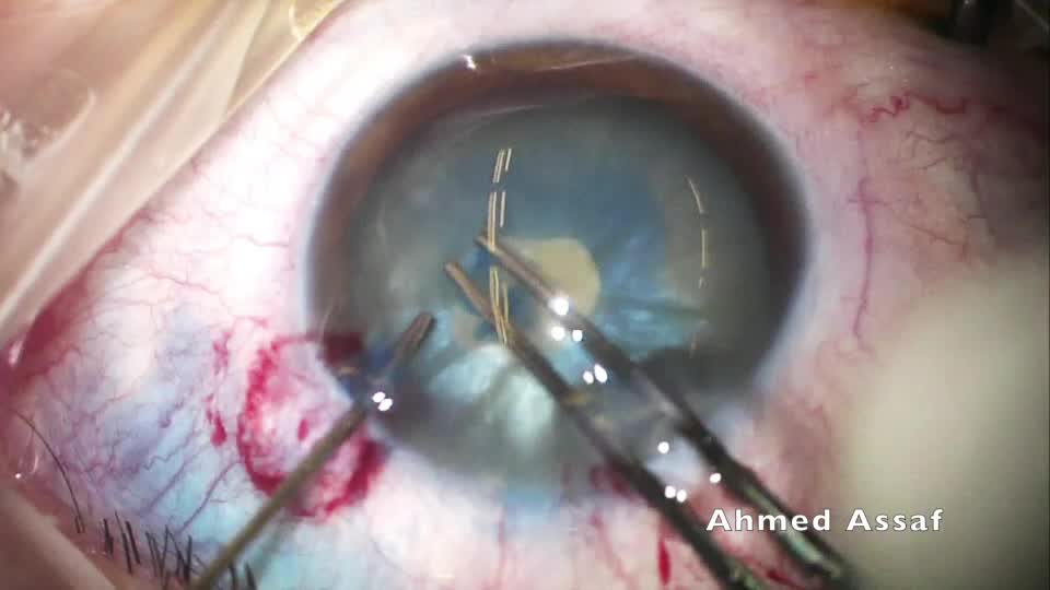 Intumescent Cataract