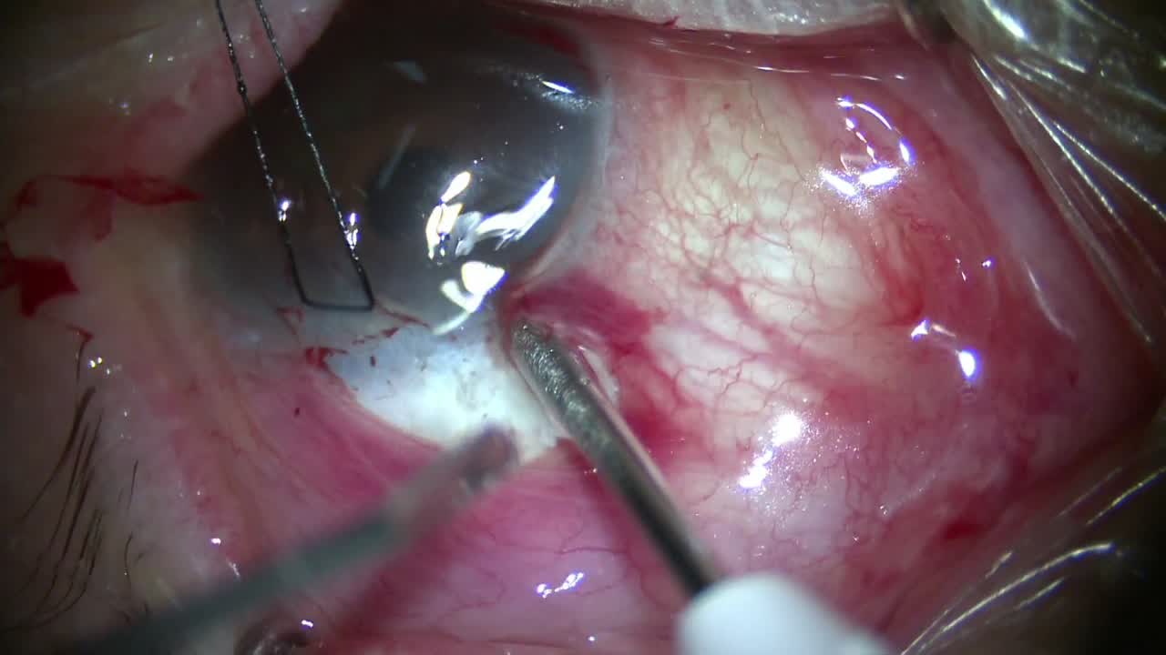 Open Conjunctiva Ab-Externo Xen Placement