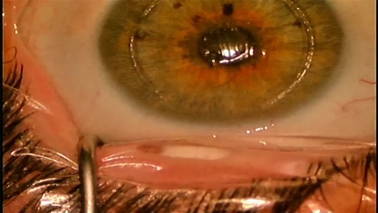 Explantation of Raindrop&reg; Corneal Shape-Changing Hydrogel Inlay (ReVision Optics)