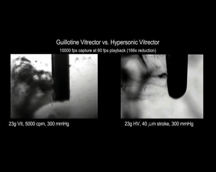 Hypersonic Vitrectomy
