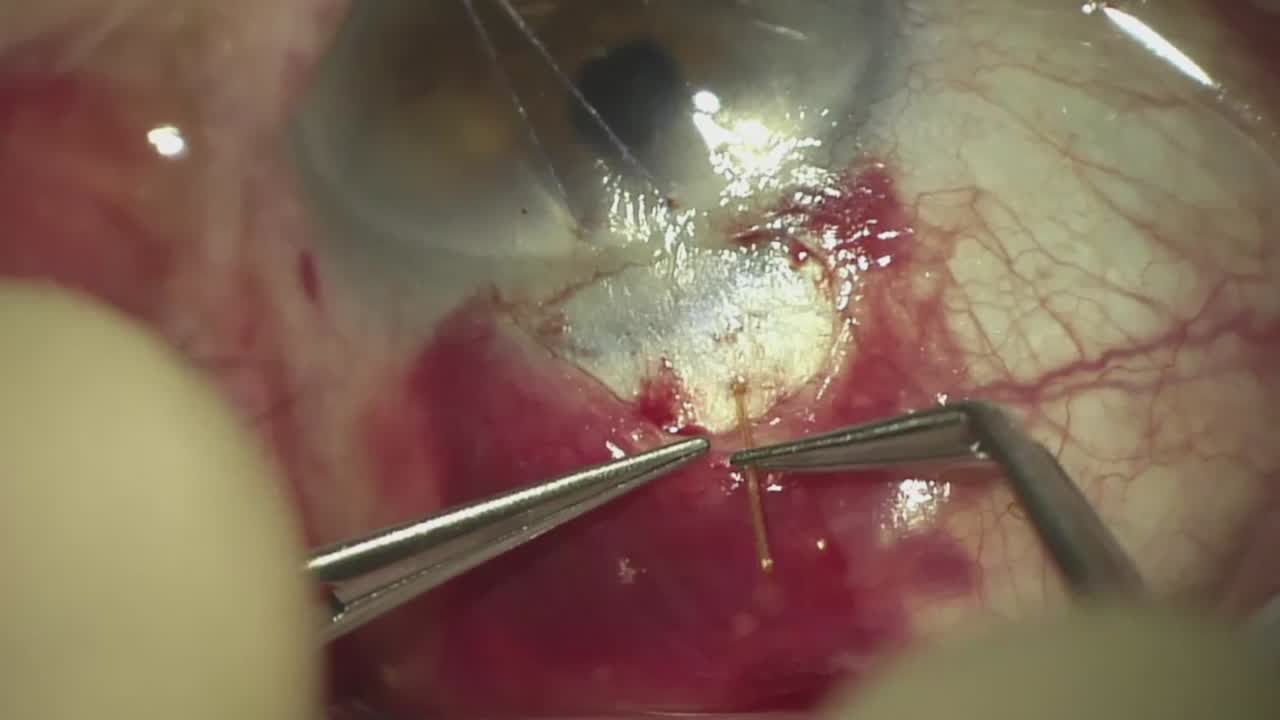 Open Conjunctiva, Ab Externo Xen Gel Stent