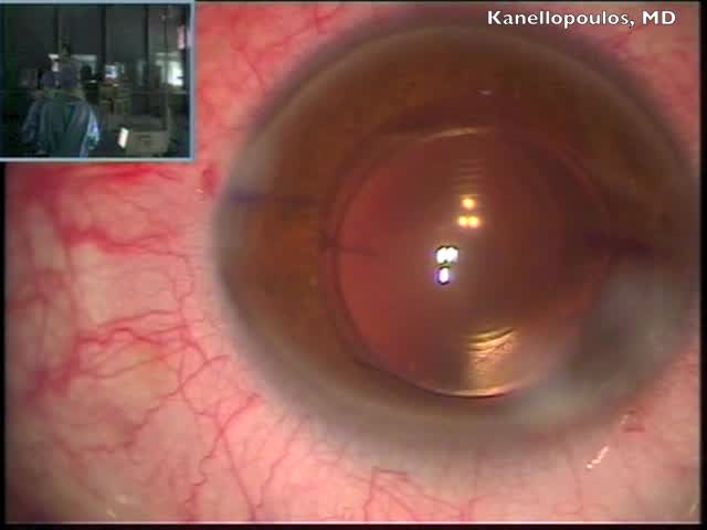 Toric Trifocal AT LISA IOL Implantation After LVC