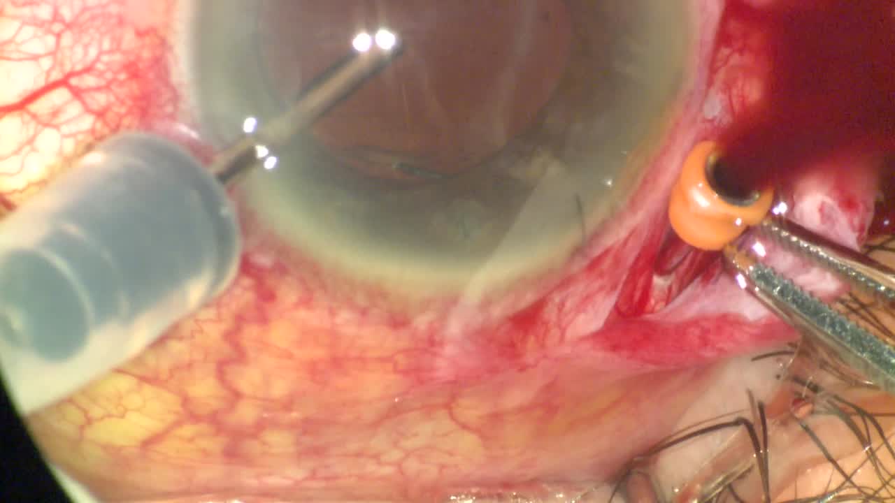 Hemorrhagic Choroidal Drainage 