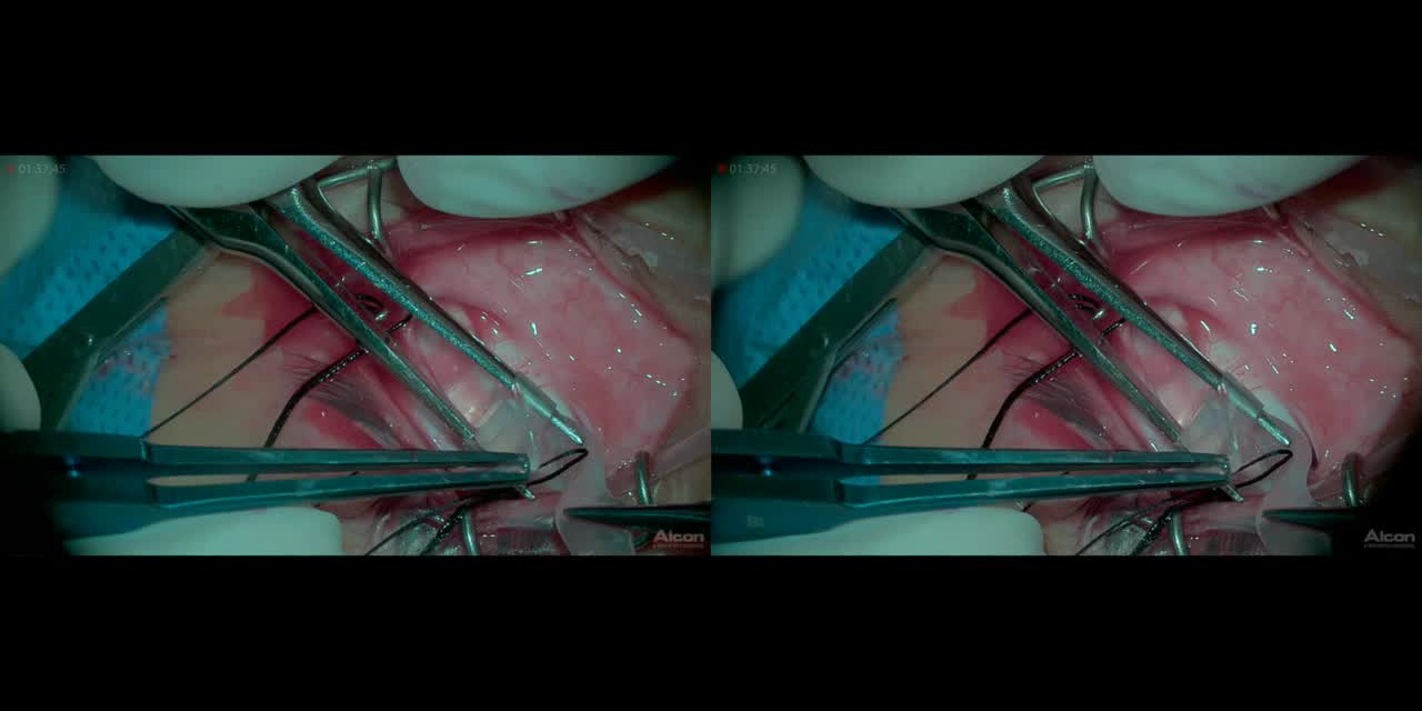 Heads-Up Scleral Buckling With a Chandelier Light (3-D)