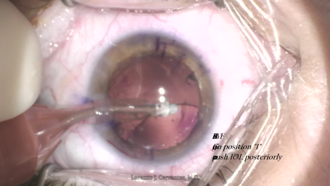 Removing Viscoelastic From Behind The IOL - Eyetube