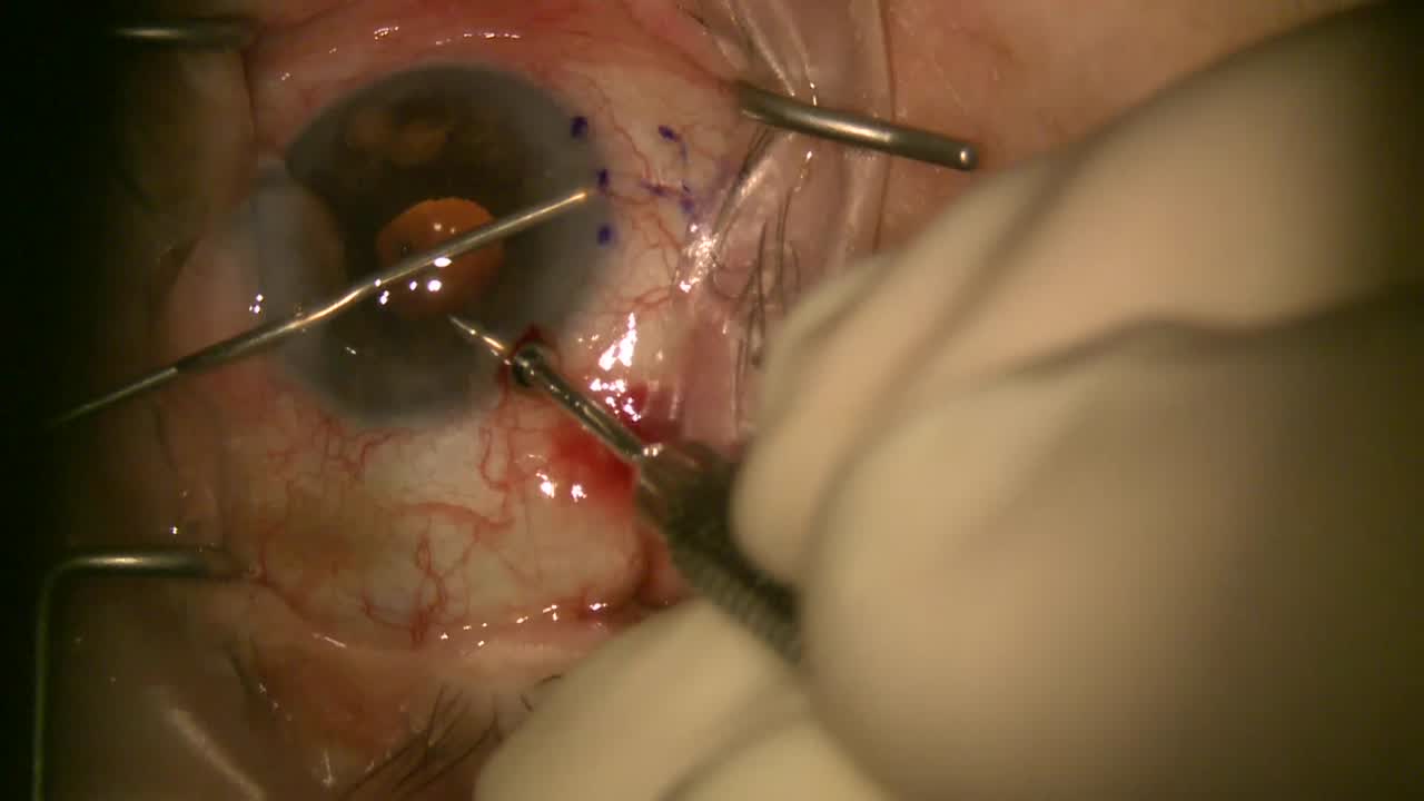 XEN Implantation Pearls